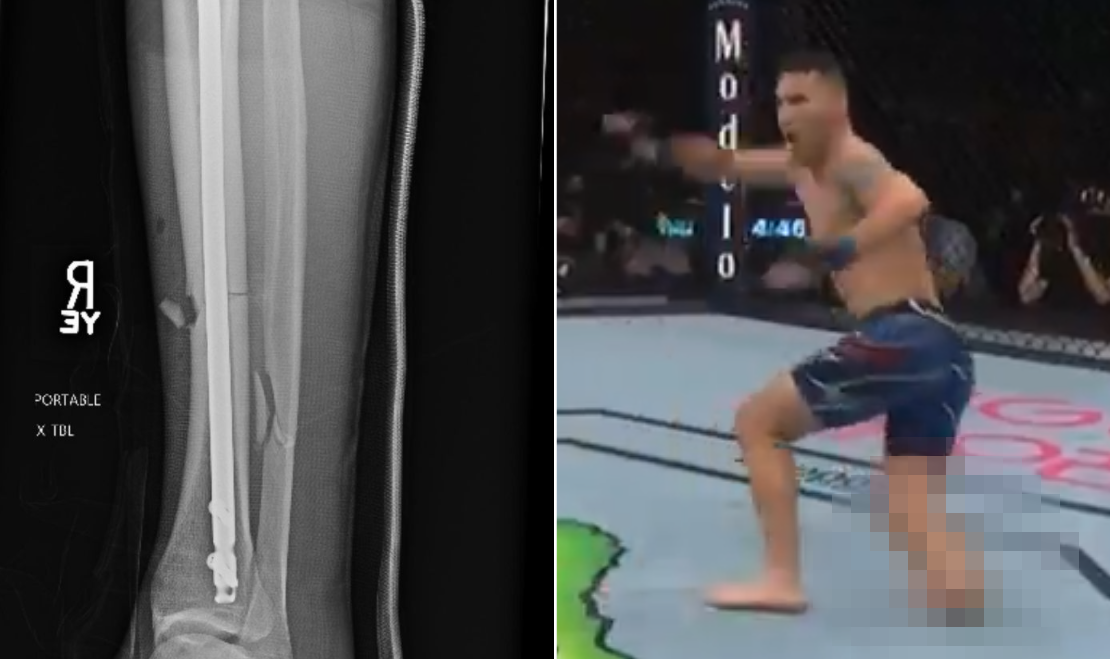 Zawodnik UFC Chris Weidman pokazał zdjęcia rentgenowskie złamanej nogi [FOTO]